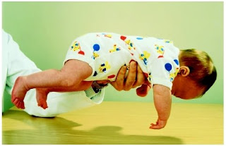 causas de la hipotonia muscular en bebes causas de la hipotonia muscular en bebes